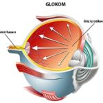 Glokom nedir? Glokom tedavisi nasıl yapılır?