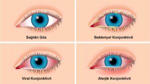 Göz alerjisi nedir?