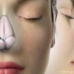 What is nose surgery for