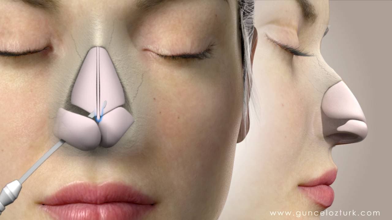 What is nose surgery for