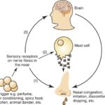 What is rhinitis How is it treated, what is the treatment process