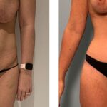 female tummy tuck