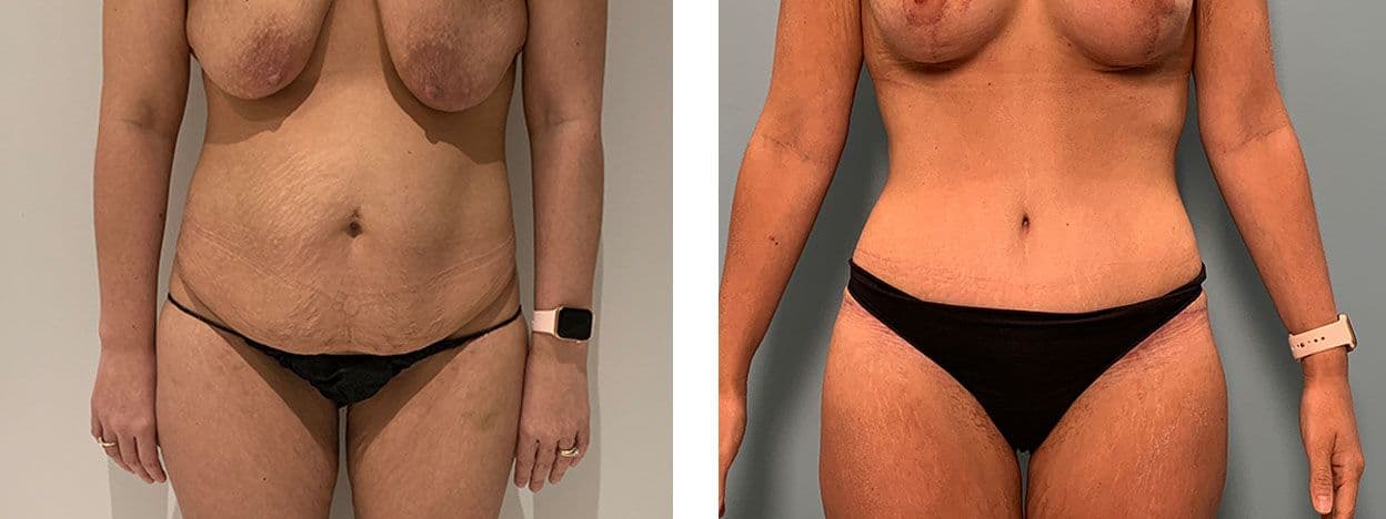 female tummy tuck