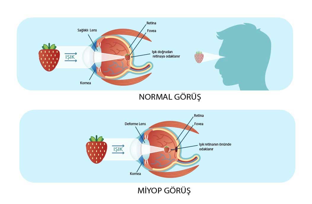 Miyopi Nedir? miyop Tedavisi nasıl yapılır?